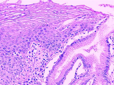 Gastro-Esophageal Junction | Medical laboratory, Stratified squamous ...