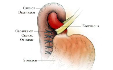 Laparoscopic Nissen Fundoplication | Memorial Hermann