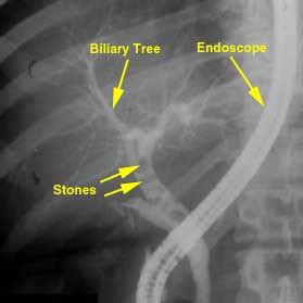 Endoscopic Retrograde Cholangiopancreatography | UW Health | Madison, WI