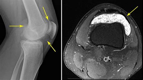 Synovial Chondromatosis - OrthoInfo - AAOS