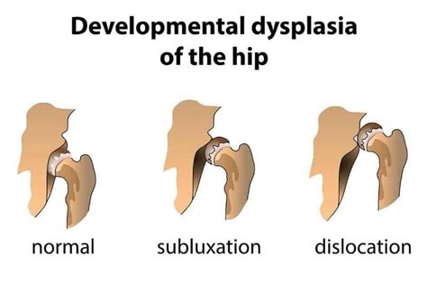 Canine Hip Dysplasia – Facts and Symptoms | German Shepherd Country