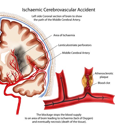 Pathophysiology | Neuro4Students