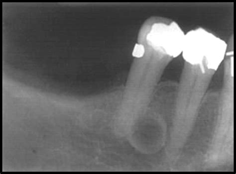 Lateral Radicular Cyst - OziDent