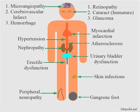 Difference Between Type 1 and Type 2 Diabetes Mellitus, and Complications - Labpedia.net