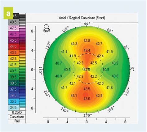 Identifying patients with keratoconus