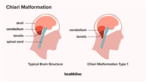 Low-Lying Cerebellar Tonsils and Migraine or Other Headaches