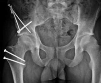 Acetabular Retroversion | Musculoskeletal Key