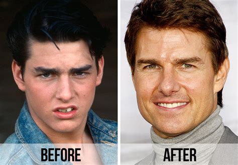 21 Celebrity Dental Implants And Veneers: Before And After - SHEfinds