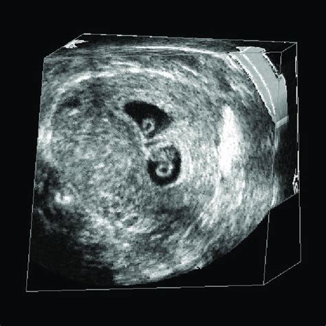 (PDF) Three-dimensional ultrasound imaging