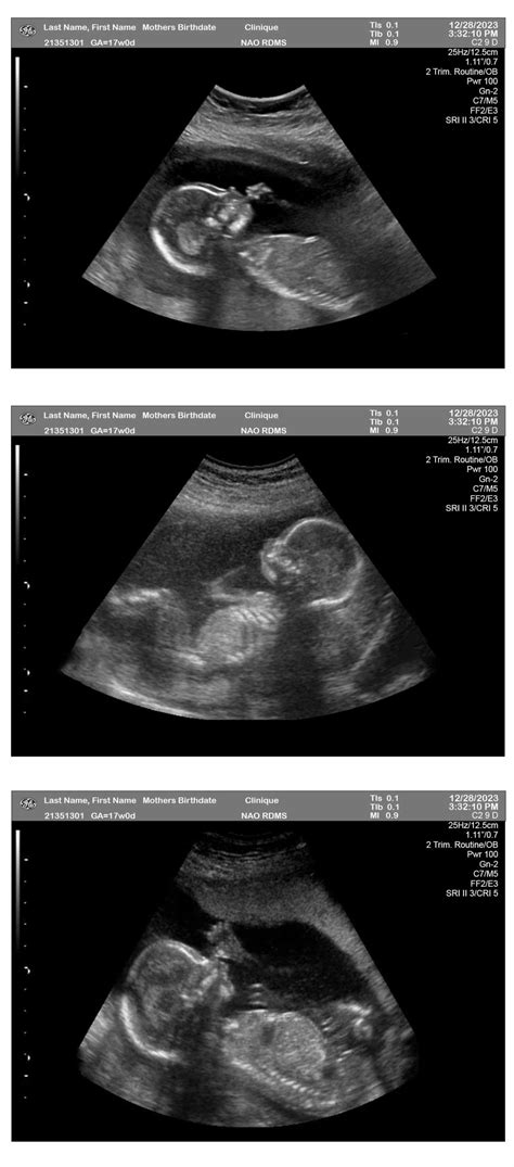 17 Week Pregnancy Ultrasound - Ultrasounds