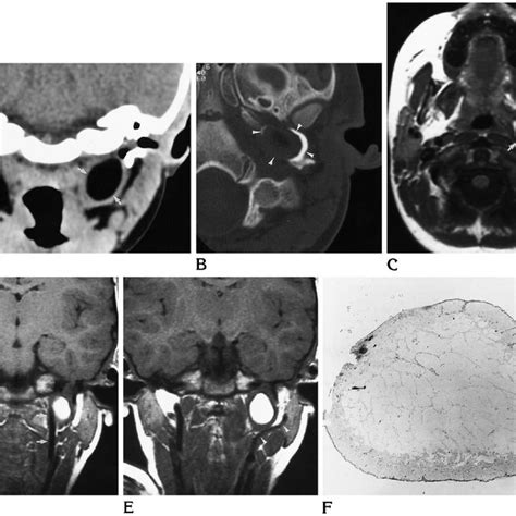 Case 1. A, Coronal CT scan shows a low-attenuation mass surrounded by a... | Download Scientific ...