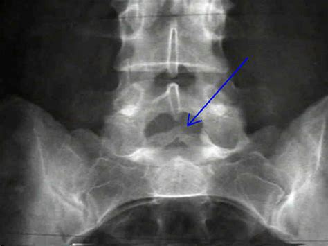 Spina Bifida : Wheeless' Textbook of Orthopaedics