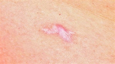 Atrophic scarring: What it is and how to treat it