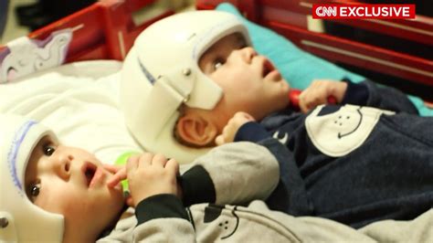 Risky surgery separates 10-month-old from parasitic twin - CNN