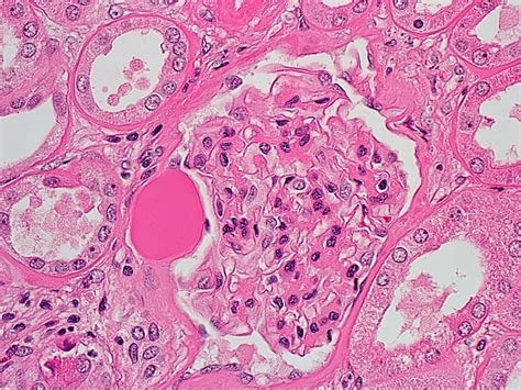 Pathology Outlines - Diabetic kidney disease