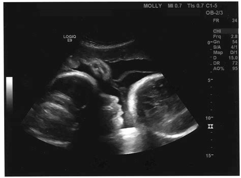 week 36 pregnancy ultrasound