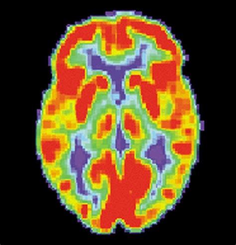 Brain Scans To Help Determine Treatment For Depression? | CommonHealth