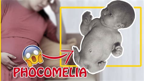 How did this drug cause babies to be born without limbs⚠️😱 ( phocomelia! ) - YouTube