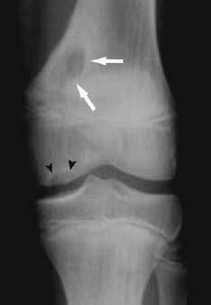 69 Brodie’s Abscess (Subacute Osteomyelitis) | Radiology Key