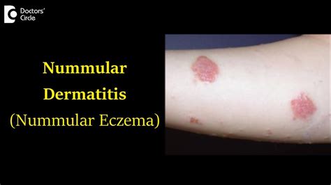 Nummular Dermatitis (Nummular Eczema) Causes , Symptoms and Treatment-Dr. Nischal K| Doctors ...