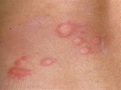 Childhood rashes, skin conditions and infections: photos - BabyCentre