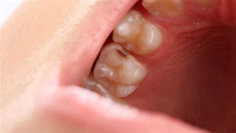 7 Common Signs and Symptoms of a Tooth Cavity | Absolute Dental