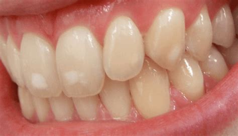 What Causes White Spots on Teeth? - Dentistry Book