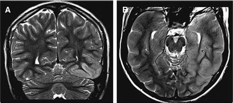 MRI of brain. There is cortical thickening with mildly associated... | Download Scientific Diagram