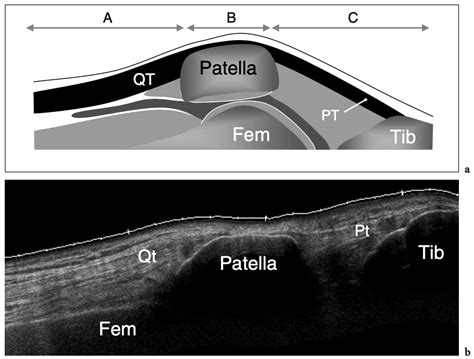 Ultrasound of the Musculoskeletal System - Chapter #14: Knee - NYSORA | NYSORA