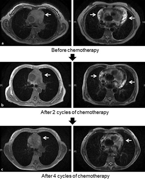 MRI of the chest before chemotherapy (a), after 2 cycles of... | Download Scientific Diagram