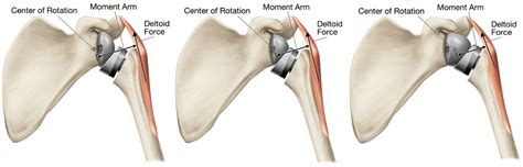 JFMK | Free Full-Text | Reverse Shoulder Arthroplasty Biomechanics