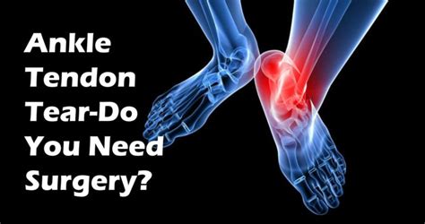 Do You Have an Ankle Tendon Tear? Most don't need surgery...