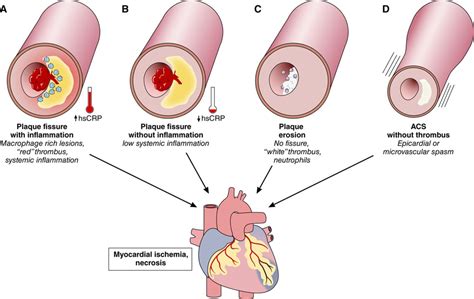 Acute Coronary Syndromes | Circulation