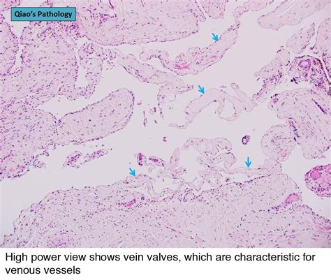 Pathology Outlines - Venous hemangioma