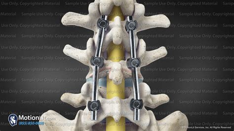 Posterior L4-L5 Spinal Fusion - MotionLit