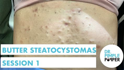 Steatocystoma Station - Dr. Pimple Popper