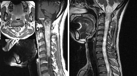 Intramedullary Spinal Cord Tumor | The Neurosurgical Atlas, by Aaron Cohen-Gadol, M.D.