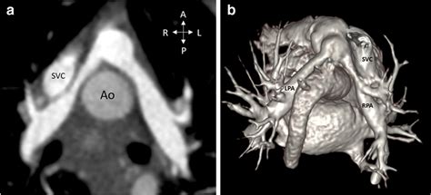 Two-month-old boy with d-TGA status post arterial switch operation. a... | Download Scientific ...