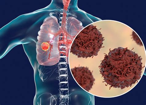 Lung cancer: Causes and treatment