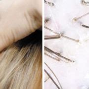 Trichogram – hair examination - Clinica Cosmetologica dr Igor Michajłowski Gdańsk