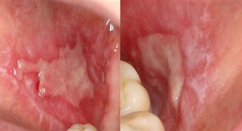 Oral Lichen Planus