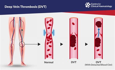 Deep Vein Thrombosis (DVT) | CFCH | Centre for Clinical Haematology