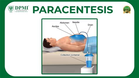 Paracentesis: Peritoneal Fluid Analysis Or Ascitic Fluid Analysis? Ascites : Causes & Symptoms ...