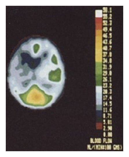 PET. Sequential PET studies of a patient with a ruptured PCA aneurysm ...