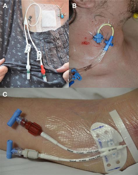 Central venous catheters. - Semantic Scholar