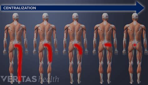 What Is the McKenzie Method for Back Pain and Neck Pain? | Spine-health