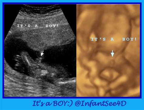 Its A Boy 3d Ultrasound