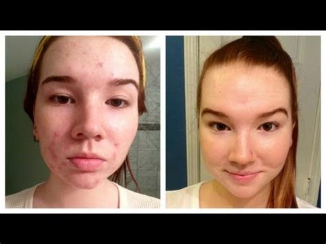 Sudocrem Acne Treatment Benefits and Instructions - BeautyHealthPlus