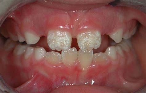 Enamel Hypoplasia: Causes, Symptoms, and Treatment | HubPages