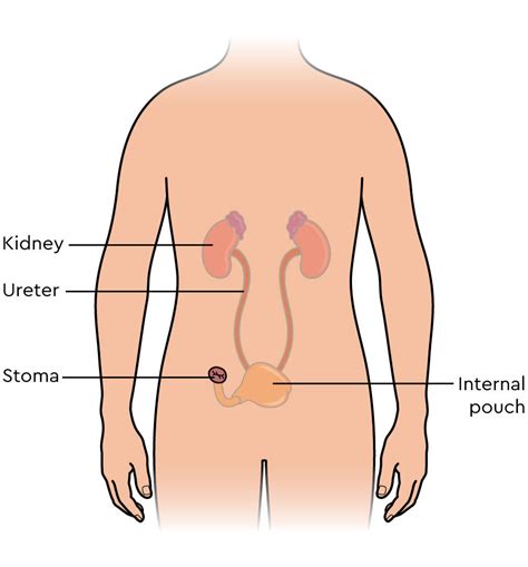 Urinary diversion; Ileal Conduit